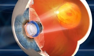 Vision Accomplished: The Bionic Eye